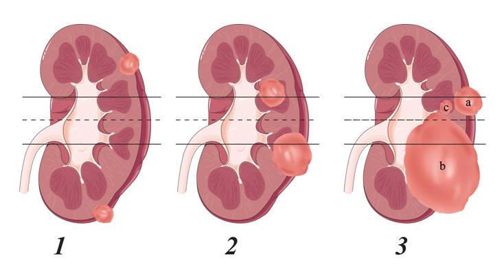 Nephrometry is a novel scoring system that quantifies the salient anatomy of renal masses in order to provide a useful clinical tool for: (1) guiding