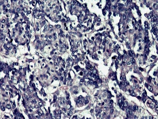 Figure 3 photomicrograph showing metastatic renal carcinoma clear