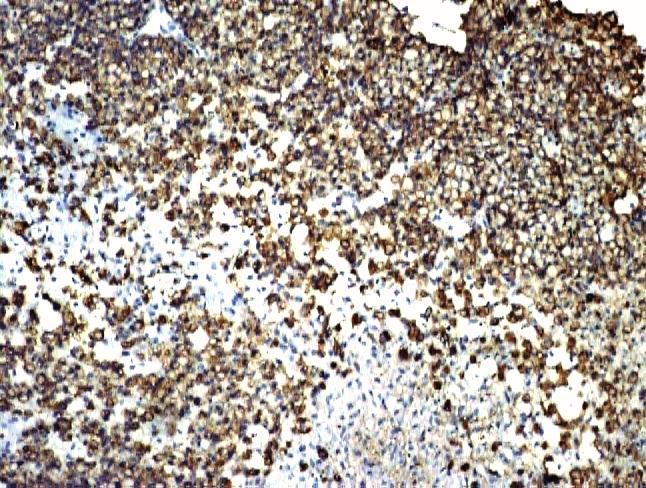 Mathur SK et al. American Journal of Medical Case Reports 2014, 2:1-8 Page 5 of 8 Figure 5 photomicrograph showing CAM5.2 positivity in metastatic renal carcinoma clear cell variant IHC (CAM5.