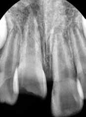 The upper central incisors did not respond to the electric pulp test or cold test.