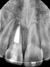 At this time, the periradicular lamina dura appeared to be intact with a normal periodontal ligament (PDL) width, except in the periapical region.