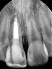 In order to compensate for possible relapse due to the rebound phenomenon, the tooth was over-extruded orthodontically by approximately 1 mm (Fig. 6).