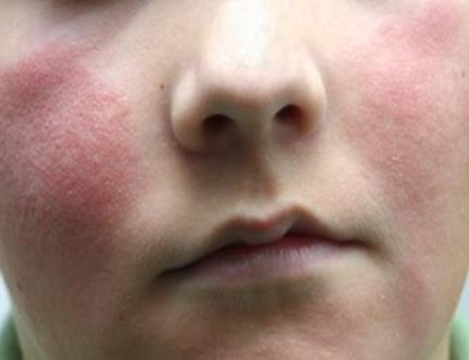 Answer 3- Slapped Cheek Syndrome/ Fifth Disease/ Parvovirus B19 Presents with: high temperature of 38C or more Coryza and sore throat Headache After 1 to