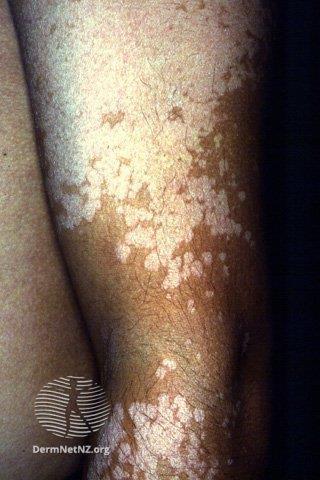 Pityriasis versicolor - Yeast skin infection Malassezia - Not contagious - More common in hot, humid climates - Clinical features: brown/red/hypopigmented patches, scaling