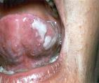 Differential Diagnosis: Generalized Rash Trunk rash Secondary