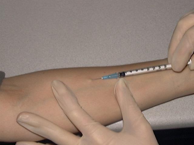 Administering the Tuberculin Skin Test Inject intradermally 0.
