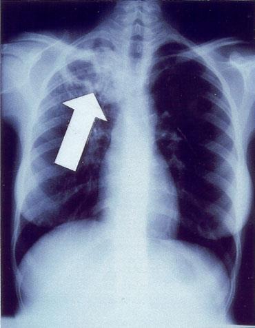 Chest Radiograph Abnormalities often seen in apical or posterior segments of upper lobe or superior segments of lower lobe May