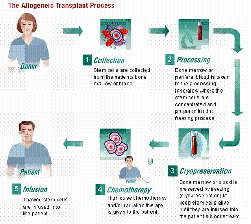 How does transplant work