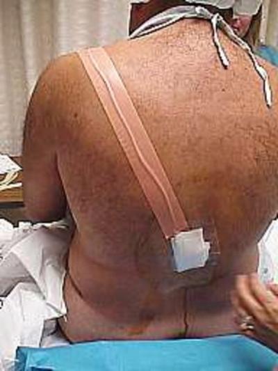 Figure 21 Figure 22 Image 15: The end of the catheter will be taped somewhere to the shoulder WHAT DO I HAVE IN MY BACK?