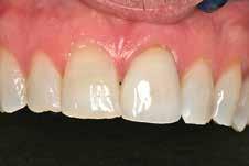 This is possible if you establish a stable occlusal design from the beginning. Then you can restore an individual in any number of phases, if needed.