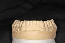 Therefore, to create a stable, esthetic restorative result the patient needed his entire dentition restored.