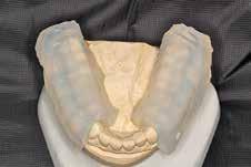 veneers6 At the end of treatment, fabricate a mandibular occlusal orthotic.