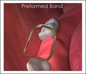 Unit 3: Surgical Procedure The band may be