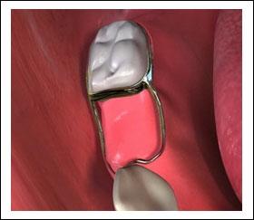23) Cementation First the band and loop should be tried in to