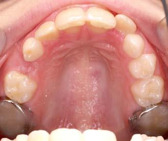 Remove the BWS if TRAINER compliance is a problem and re-evaluate the patients treatment plan. Do Not Overactivate ANTERIOR ARCH UNCROWDED Don t be tempted to try to expand the molars using the BWA.