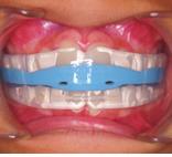ARCH DEVELOPMENT WITH BWS This dual effect provides a powerful tool in correcting many difficult malocclusions, with less treatment time, less requirement for extractions, with decreased tendency to