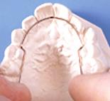 ideal arch shape between the distal