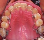 Remove the BWA, place two Begg premolar brackets in bracket holders with wire slot directed towards the gingival.