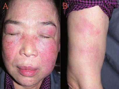 Fig. 1 (A) Erythema and edema on the cheeks and nasal root, and typical heliotrope sign. (B) Several erythematous to violaceous indurated plaques with mild depression on both upper arms.
