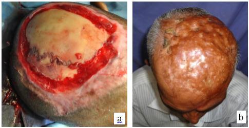 Fig. 4: Burr holes followed by ssg in scalp defect following animal attack (Bear) Fig. 5: ssg after excission of scalp vascular malformation AUTHORS: 1. Sathyanarayana B. C. 2.