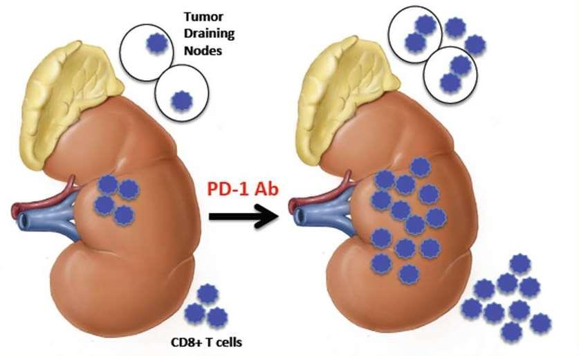 Most intra-tumoral immune cells in ccrcc may be immunosuppressive tumor-promoting PD1+ cells Significant decrease in circulating PD-1+ PBMCs