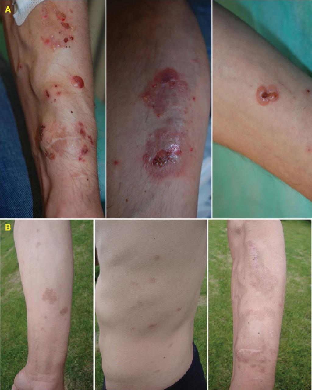 K. Osipowicz et al. Bullous pemphigoid and haemodialysis Figure 1 Clinical characterisation of the current patient. (A) Tense blisters located on the forearms before treatment, (B) after treatment.