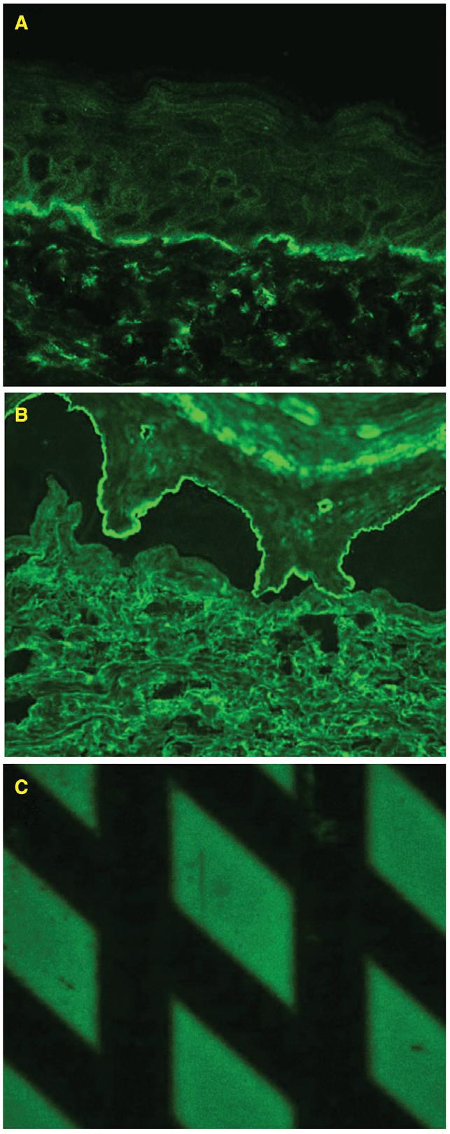 Bullous pemphigoid and haemodialysis Figure 2 BIOCHIP: reactivity of circulating IgG with (A) the epidermal side of the salt split skin and (B) recombinant NC16a domain of the BP180 BMZ antigen.