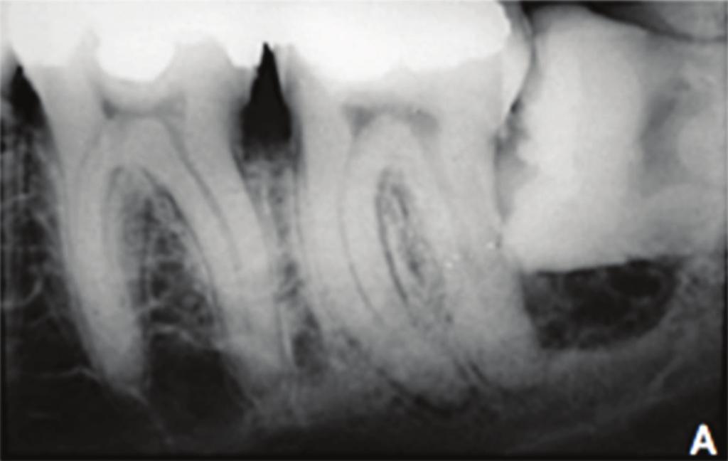 2 Case Reports in Dentistry (a) (b) (c) Figure 1: (a) Periapical X-ray showing a radiolucency surrounding the crown of the left third molar suggestive of dentigerous cyst.