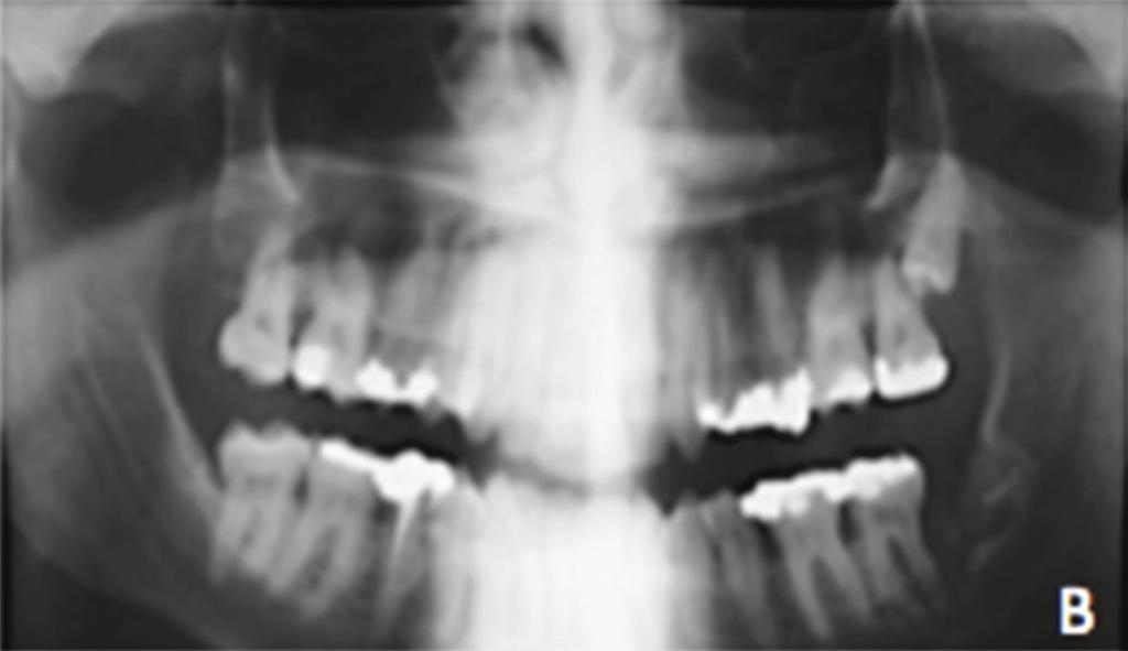 Figure 2: Immediately postsurgical treatment panoramic X-ray, which shows fibula free flap reconstruction of the mandible.