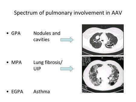 4 di 23 So, the spectrum of pulmonary involvement in ANCA-associated vasculitis is quite wide.
