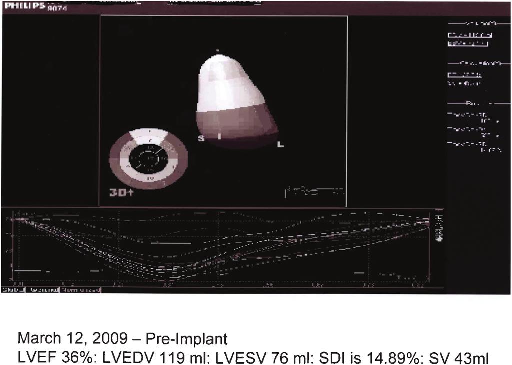 CRT: Improving Patient Selection and Outcomes Figure 1: This is an example of one subject s three-dimensional echocardiogram prior to cardiac resynchronization therapy.