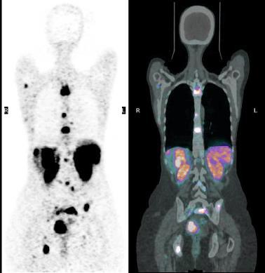 Analogs Positron Emission Tomography/ Computed Tomography in Gastroenteropancreatic