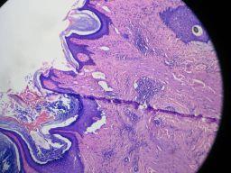 Figure 2 : Histopathology showing hyperkeratosis, keratotic plugging, irregular acanthosis, suprabasal bulla with basal cells arranged in row of tomb stone appearance with mixed inflammatory