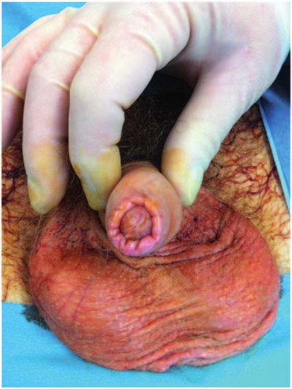 M Shabbir, S Minhas et al. Figure 2. Bowenoid Papulosis of the penile shaft. Figure 4. Genital lichen sclerosus affecting the foreskin causing phimosis.