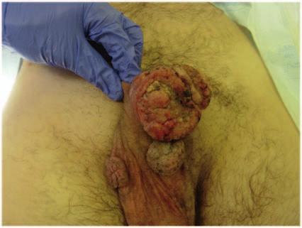 malignant transformation in less than 1% of cases, primarily in immunocompromised patients [von Krogh and Horenblas, 2000].
