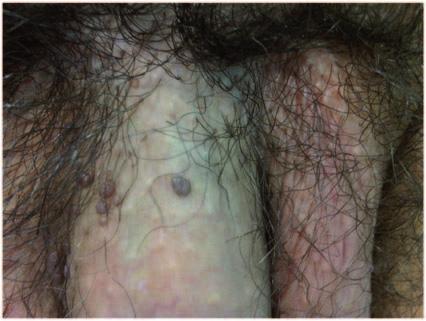 On the penis, they primarily occur around the coronal sulcus and frenulum, but can also be found as flat lesions on the penile shaft.