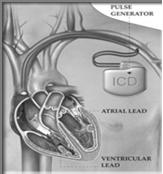 ICD (Implantable Cardioverter Defibrillator)