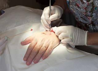 2 Overview of treatments Surgical methods What are the advantages of Mohs surgery? Your doctor will know on the spot whether more tissue needs to be removed in order to get rid of all the cancer.