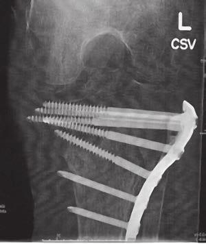 Figure A. Intra operative anterior-posterior radiograph placement of CERAMENT BONE VOID FILLER Figure B.