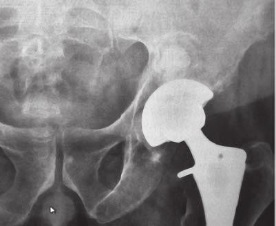 Case 2 : Reconstructive Orthopedics Hip Revision A 61-year old male with a history of well- positioned, well functioning bilateral uncemented THAs presented with progressive left hip