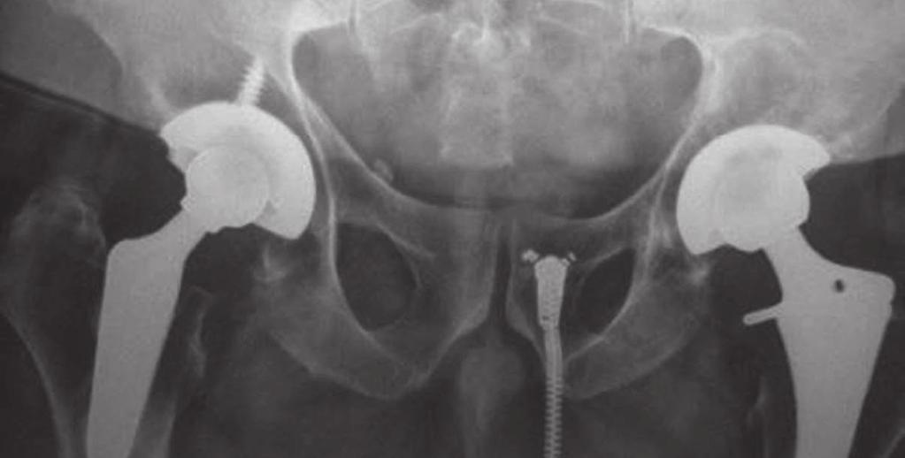 X-rays confirmed good positioning of the acetabular implant CERAMENT is still visible (Fig. 2). At 11 weeks post-op, CE- RAMENT is no longer visible (Fig. 3).