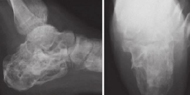 Case 3 : Foot and Ankle Treatment of displaced intra-articular calcaneal fracture A female (54 years old)