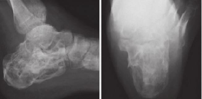 A). The resulting bone void after fracture reducation was filled with CERAMENT BONE VOID FILLER. Figure A.