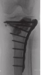 radiograph demonstrating complete