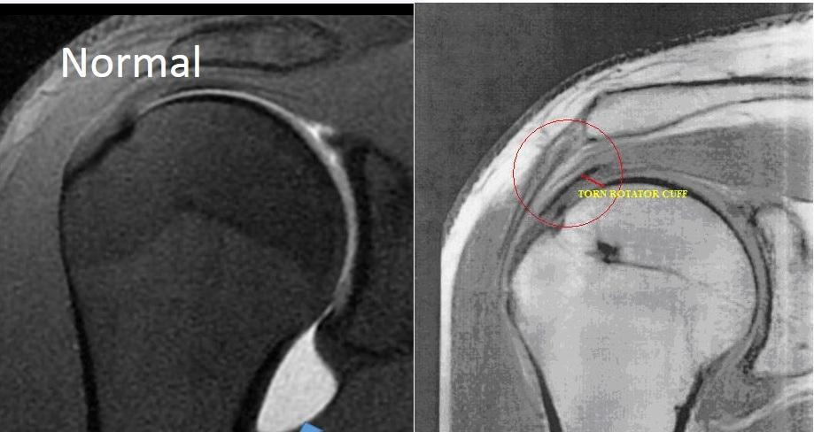 An MRI of a normal right rotator cuff viewed from the front (coronal) image Nonoperative Nonoperative treatment is often successful in alleviating issues with rotator cuff tendonitis.