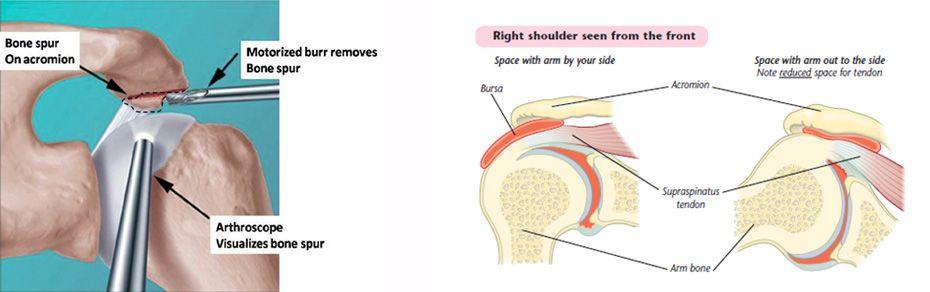 relieves the pressure on the rotator cuff and relieves the pain associated with rotator cuff tendonitis. Shoulder arthroscopy diagram on right showing removal of bone spurs.