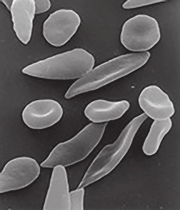 8 3 Fig. 3.1 shows a photomicrograph of red blood cells of a person suffering from sickle cell anaemia. Both normal and abnormal red blood cells are shown. abnormal cell normal cell (a) Use Fig. 3.1 to complete this table: Fig.
