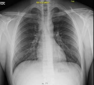 CXR 6 weeks after ART CXR at the end of Therapy Treatment Outcomes Person with TB HIV Infection and Bipolar Disorder Completed TB