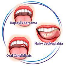 Symptomatic Infection Non-AIDS indicator conditions thrush (yeast infection of tongue/mouth) oral hairy leukoplakia (viral infection of tongue)