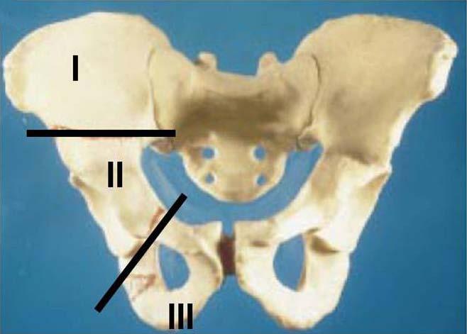 735 Pelvic Bone Sarcomas (e.g., helium, carbon) is an attractive alternative because it allows delivery of therapeutic doses (> 60 Gy) while minimizing the exit dose to adjacent normal structures.
